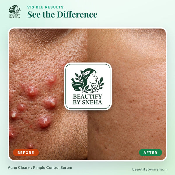 ACNE CLEAR+ : PIMPLE CONTROL SERUM