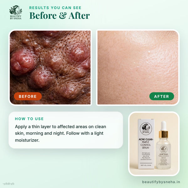 ACNE CLEAR+ : PIMPLE CONTROL SERUM