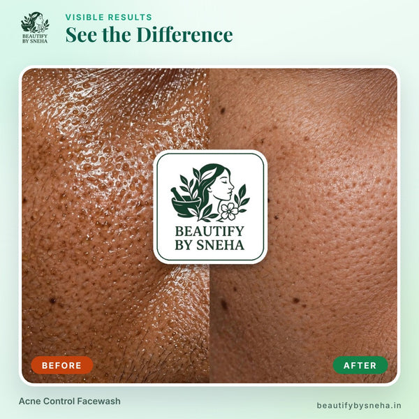ACNE CONTROL FACEWASH